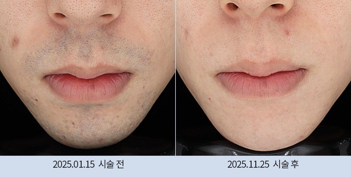 스노우의원 다산점 레이저 제모 전후