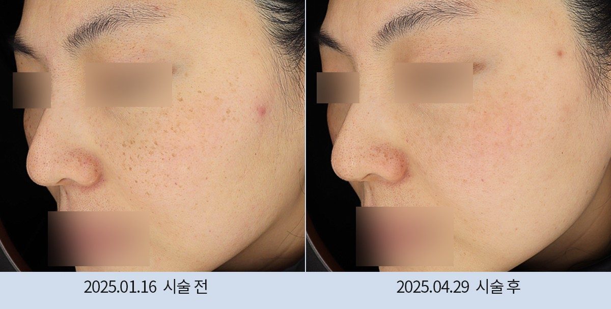스노우의원 다산점 색소 시술 전후