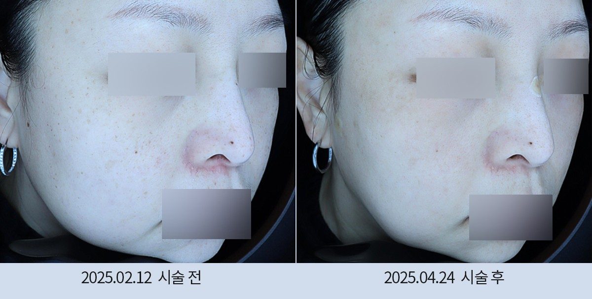 스노우의원 다산점 색소 시술 전후