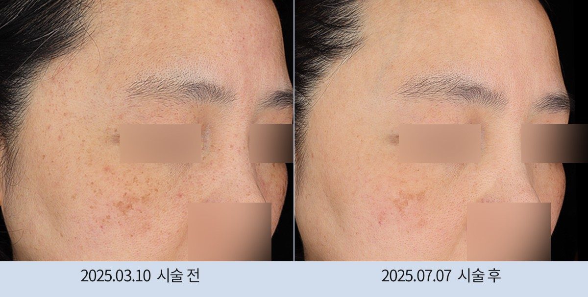 스노우의원 다산점 색소 시술 전후